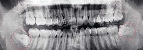 智齿牙片示意图 智齿牙片示意图