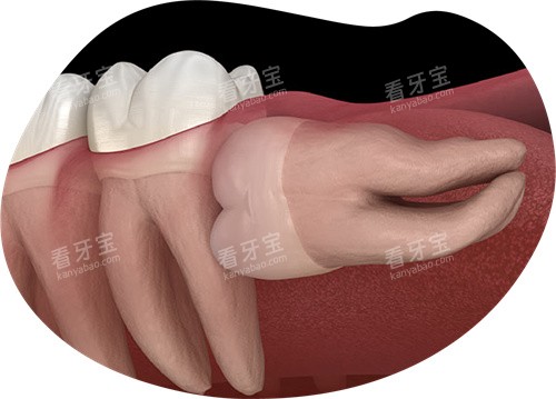 横向智齿 横向智齿