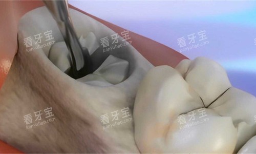 牙齿龋洞展示图 牙齿龋洞展示图