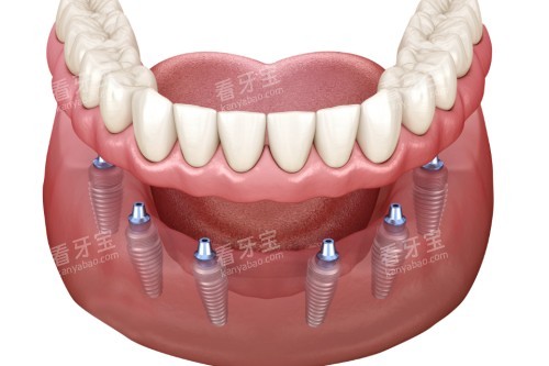 all-on-6��ֲ��ͨͼ