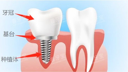种植牙卡通图示 种植牙卡通图示