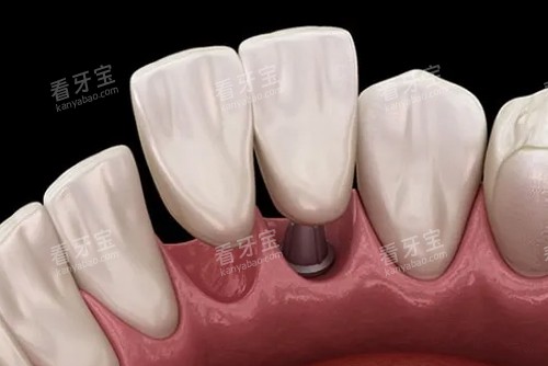 种植牙一拖二内部展示图 种植牙一拖二内部展示图