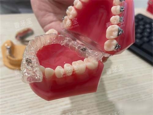 牙齿矫正隐形牙套模型 牙齿矫正隐形牙套模型