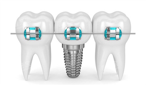 种植牙牙齿矫正图片 种植牙牙齿矫正图片