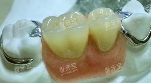 连桥冠假牙图 连桥冠假牙图