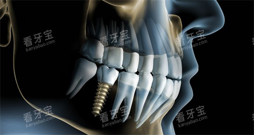 单颗种植牙动画示意图展示 单颗种植牙动画示意图展示