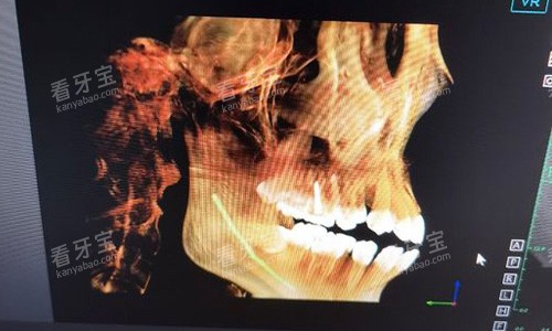 金华东阳马爽口腔牙齿拍片示意图 金华东阳马爽口腔牙齿拍片示意图