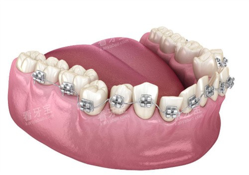 金属牙齿矫正展示图 金属牙齿矫正展示图