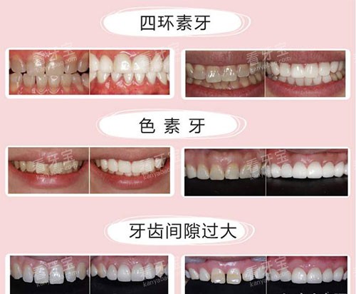 不同牙齿需要美白的示意图 不同牙齿需要美白的示意图