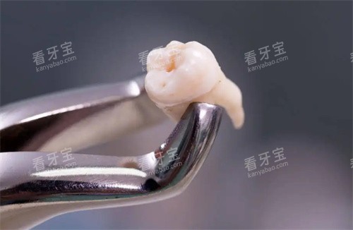 拔掉的牙齿照片 拔掉的牙齿照片