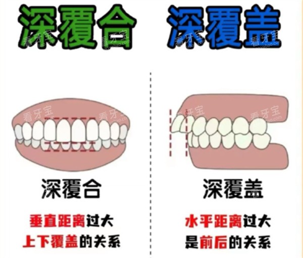 深覆合跟深覆盖的区别对比 深覆合跟深覆盖的区别对比