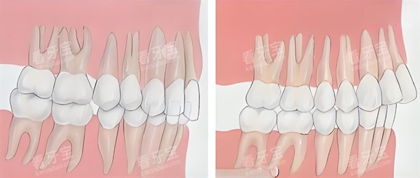 深覆合跟深覆盖对比图片 深覆合跟深覆盖对比图片