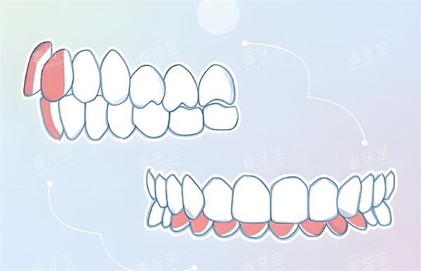 深覆合跟深覆盖对比图示 深覆合跟深覆盖对比图示