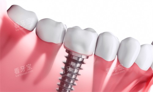 种植牙种植后的样子 种植牙种植后的样子