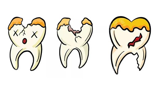 牙齿坏了一半动画图 牙齿坏了一半动画图