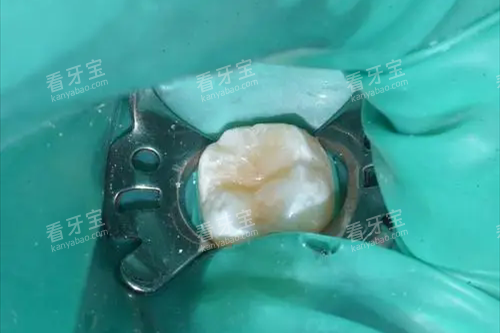 补牙橡皮障.webp 补牙橡皮障.webp