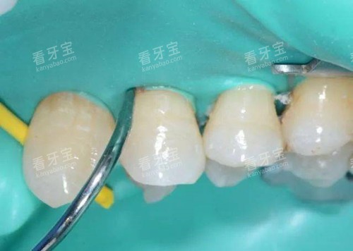 橡皮障在补牙中的运用 橡皮障在补牙中的运用