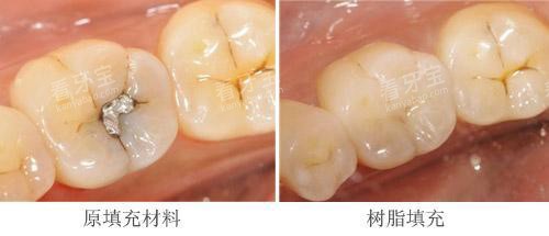 补牙材料不同示意图 补牙材料不同示意图