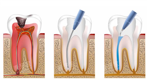 根管治疗流程图 根管治疗流程图