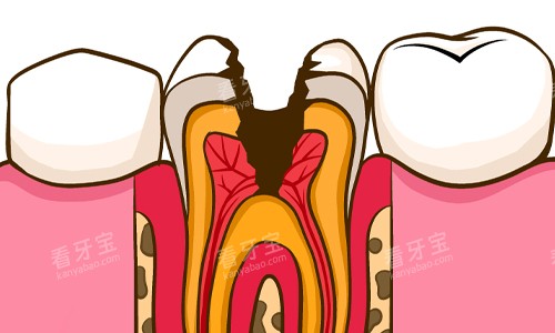 龋坏至牙髓展示 龋坏至牙髓展示