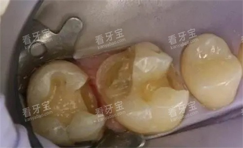 清理龋坏照片 清理龋坏照片