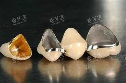 烤瓷牙图片 烤瓷牙图片