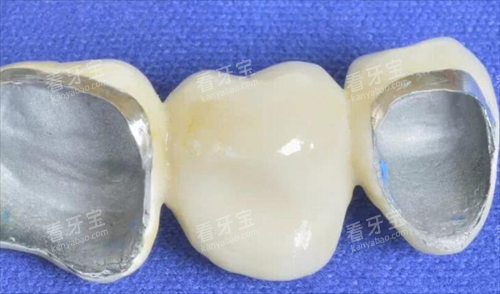 烤瓷牙模型展示图 烤瓷牙模型展示图