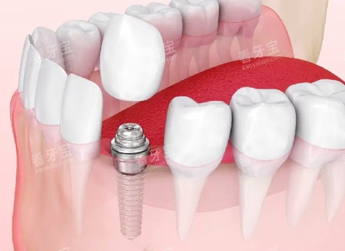 种植牙清晰展示 种植牙清晰展示