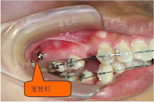 牙齿矫正骨钉种植钉口腔示意图 牙齿矫正骨钉种植钉口腔示意图