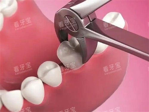 拔牙动画图 拔牙动画图