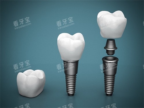 种植牙结构展示 种植牙结构展示