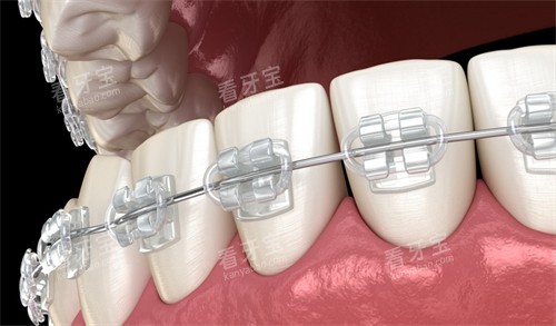 托槽矫正展示图 托槽矫正展示图