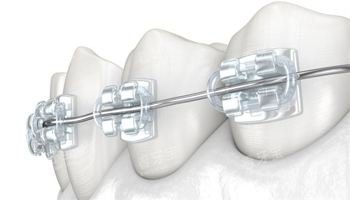 托槽矫正图示 托槽矫正图示