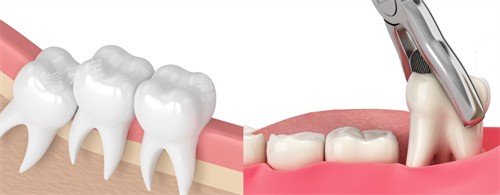 拔掉歪斜的智齿 拔掉歪斜的智齿