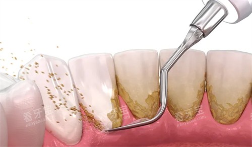 洗牙可改善牙齿污渍 洗牙可改善牙齿污渍