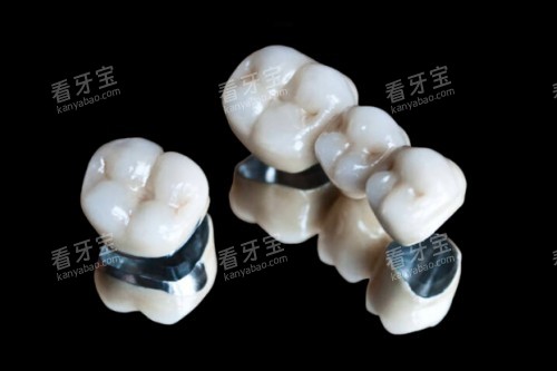 烤瓷牙冠模型图 烤瓷牙冠模型图