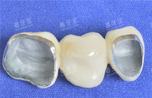 烤瓷牙冠桥 烤瓷牙冠桥