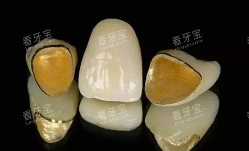 烤瓷牙冠照片 烤瓷牙冠照片