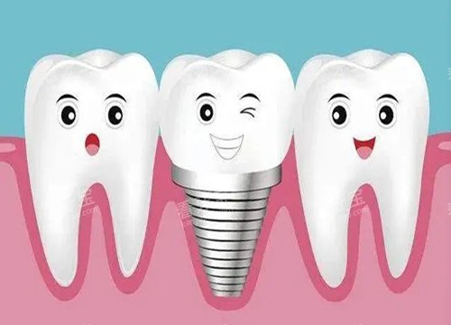 种植牙和真牙卡通示意图 种植牙和真牙卡通示意图