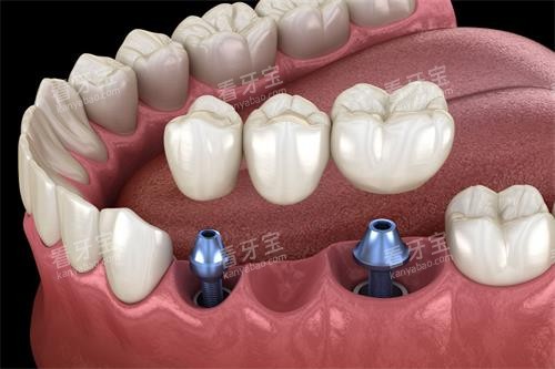 多颗种植牙图片 多颗种植牙图片