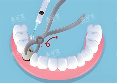 无痛拔牙 无痛拔牙