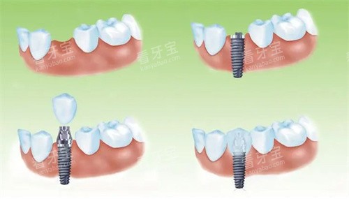 种植牙过程 种植牙过程