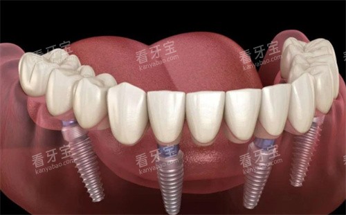 全口种植牙 全口种植牙
