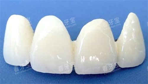 全瓷牙 全瓷牙