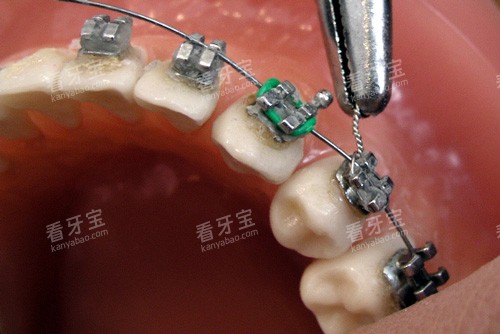 牙齿矫正器安装示意图 牙齿矫正器安装示意图