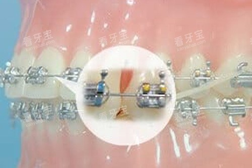 牙齿矫正细节图 牙齿矫正细节图