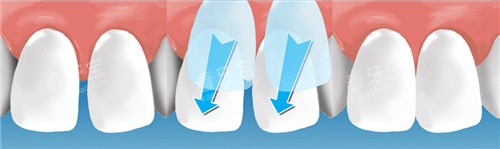 门牙贴面过程 门牙贴面过程